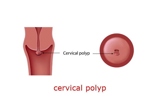 സെര്‍വിക്കല്‍ പോളിപ്‌സ്‌