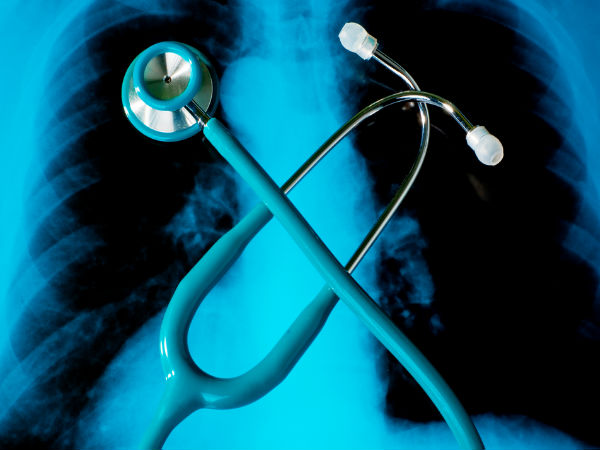 ശ്വാസകോശാര്ബുദം ശ്വാസകോശാര്ബുദം