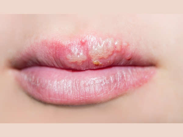 വായ്പ്പുണ്ണ്