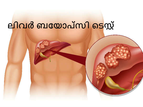 ലിവര്‍ ബയോപ്‌സി ടെസ്റ്റ്