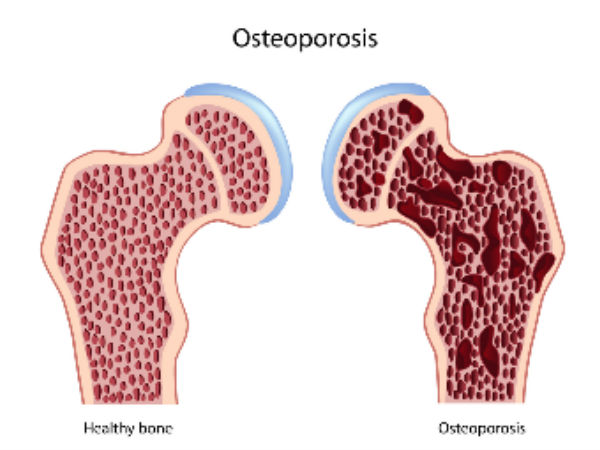 This Drink Will Destroy Your Bones From The Inside