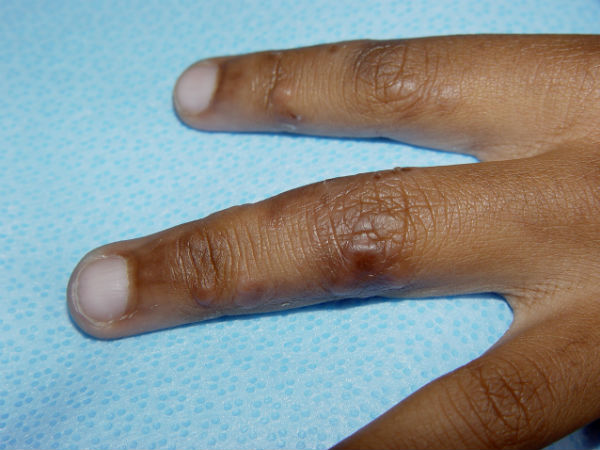 എരിക്കിന്റെ ചുന