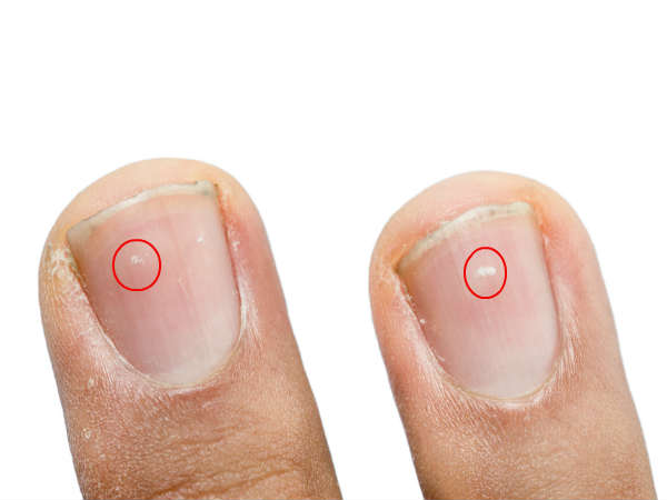  കൂടുതല്‍ നഖങ്ങളില്‍