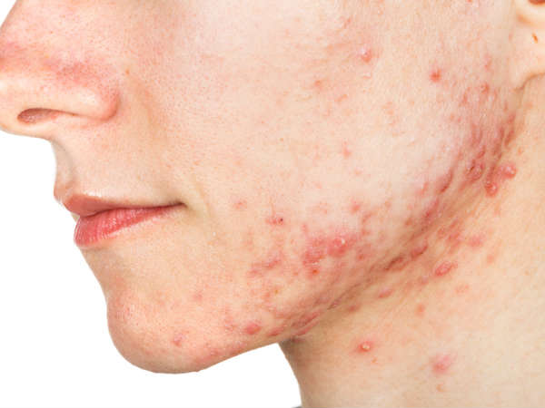  ചര്‍മ്മ പ്രശ്‌നങ്ങള്‍