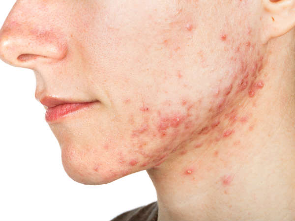 മുഖക്കുരുവിന്റെ അതിപ്രസരം