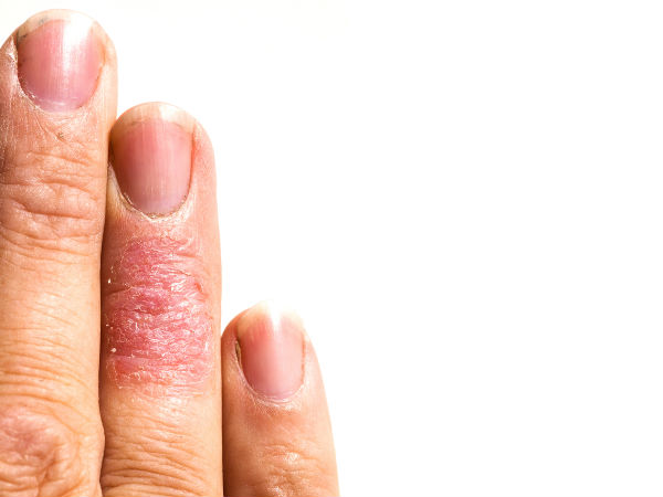 എക്‌സിമ