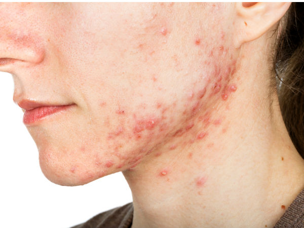  മുഖക്കുരു