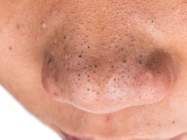 ബ്ലാക്ക്‌ഹെഡ്‌സ്