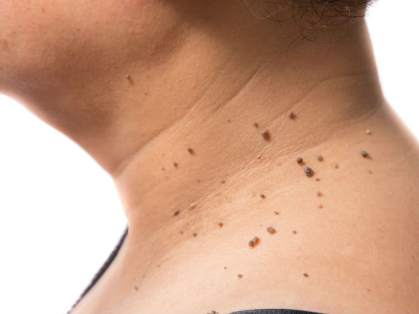 അരിമ്പാറ