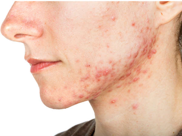 മുഖക്കുരു മാറ്റുന്നു