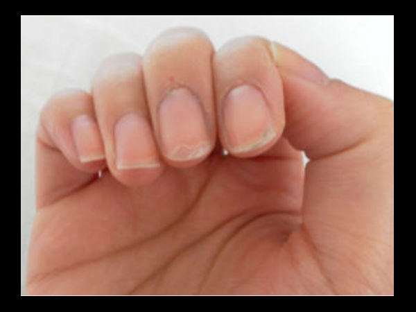 നഖം പിളര്‍ന്ന് പോരുക