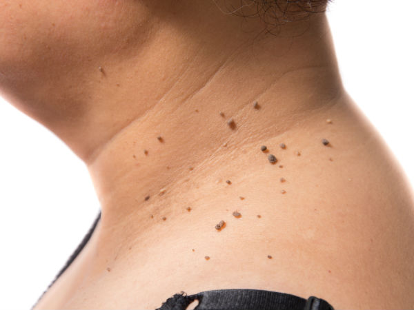  അരിമ്പാറ കളയണോ?