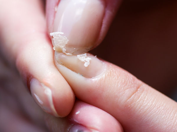 നഖത്തിന്റെ പൊട്ടല് നഖത്തിന്റെ പൊട്ടല്