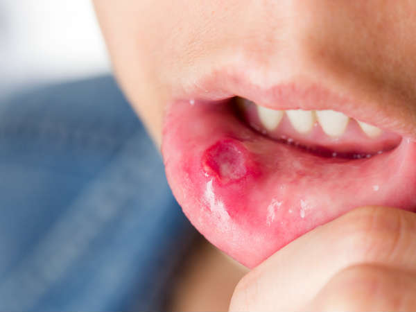  വായിലെ മുറിവ്