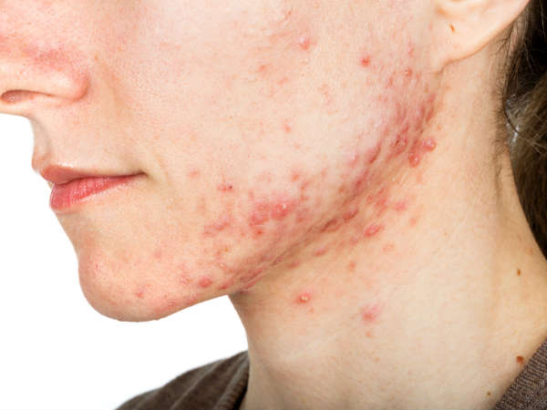  ചര്‍മ്മ പ്രശ്‌നങ്ങള്‍ ഉണ്ടാക്കുന്നു