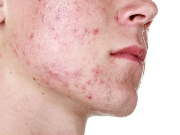 മുഖക്കുരു മുഖക്കുരു