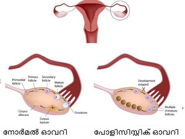 മുടി കൊഴിച്ചില് മുടി കൊഴിച്ചില്