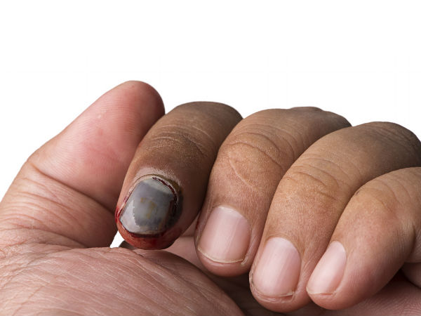 നഖത്തിനു താഴെ കറുപ്പ് നിറം