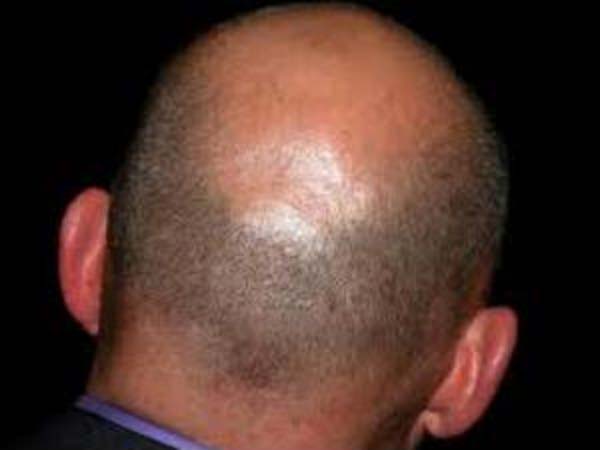 കഷണ്ടിയില്‍ മുടി കിളിര്‍ക്കും പഴക്കൂട്ട്