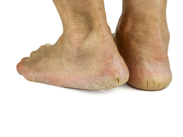 കറ്റാർവാഴ