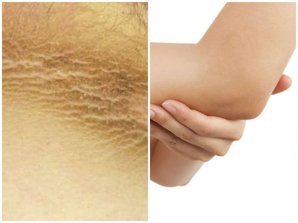  കഴുത്തിലെ കറുത്തനിറം