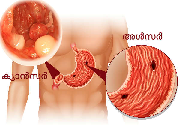  വയറു വീര്‍ക്കല്‍