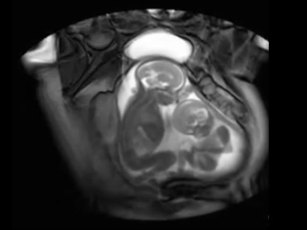 പരസ്പരം അടി