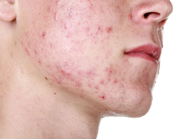 മുഖക്കുരു പാട് മാറ്റും