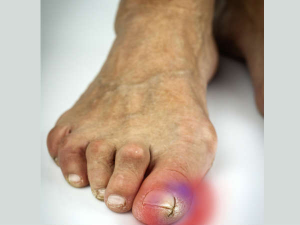 പെരുവിരലില്‍ നഖം കുത്തല്‍