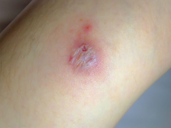 ബേക്കിങ്ങ് സോഡ