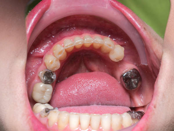 പല്ലടച്ചിരിയ്ക്കുന്നത് സില്‍വര്‍ നിറത്തിലോ, നീക്കൂ