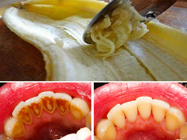 പല്ലിലെ കറ മാറ്റാന്‍