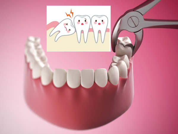 വിസ്ഡം ടൂത്ത് പറിയ്ക്കരുത്, കാരണം.......