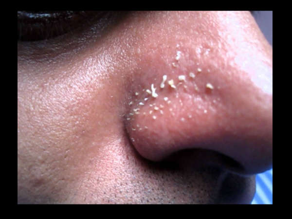 ടീ ട്രീ ഓയില്‍