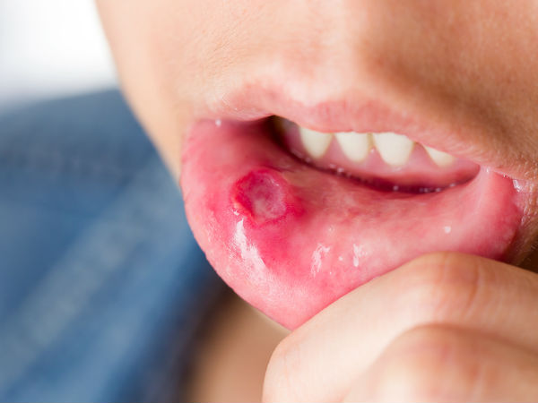  വായിലെ ക്യാന്‍സര്‍