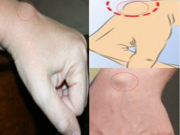 മണിബന്ധത്തില്‍ ഇതുണ്ടോ, സൂക്ഷിയ്ക്കൂ....