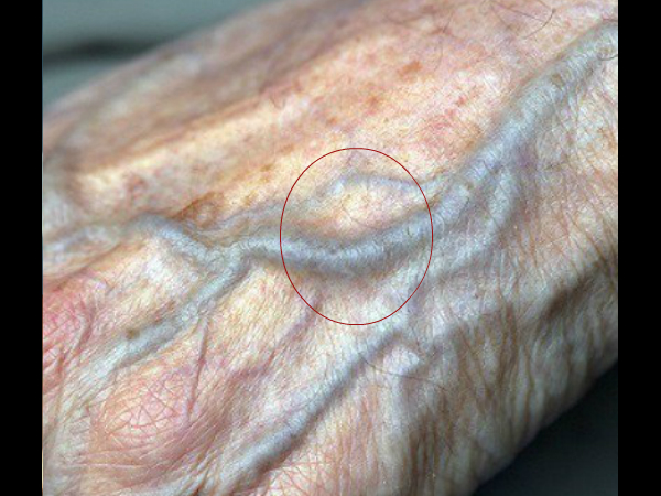 ഞരമ്പുകള്‍ ഇങ്ങനെയാണോ, സൂക്ഷിയ്ക്കൂ...