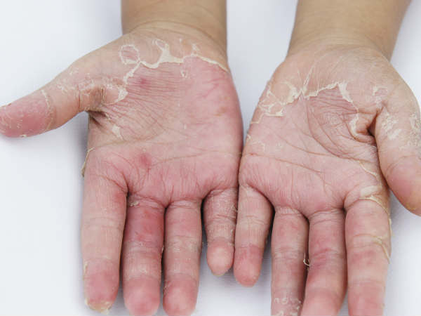 ക്യാന്‍സറിന്റെ ആദ്യസൂചന ഉള്ളംകയ്യില്‍