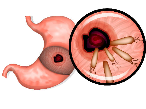 വയറ്റിലെ അള്സര് വയറ്റിലെ അള്സര്
