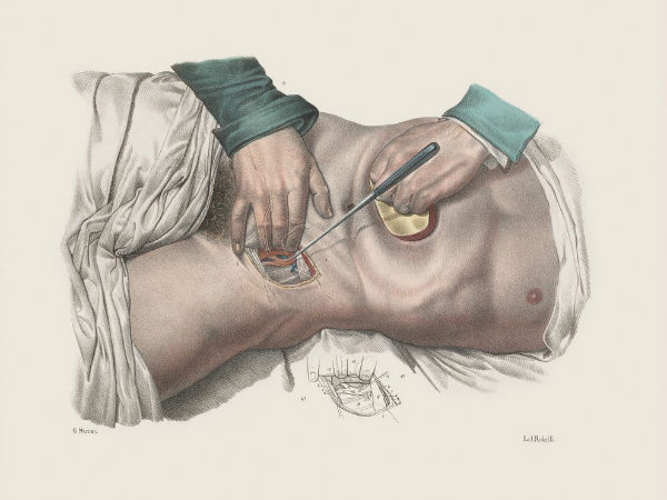  രക്തവാഹിനിക്കുഴലിലെ സര്‍ജറി