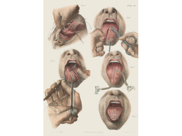 നാവിലെ ക്യാന്‍സര്‍ സര്‍ജറി