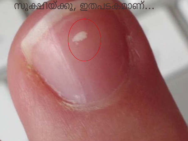 നഖത്തിലെ വെളുത്ത കുത്തിനു പുറകില്‍ ഗുരുതരരോഗങ്ങള്‍