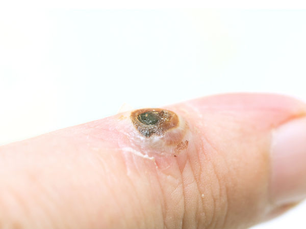 അരിമ്പാറ വരുന്നതിന്റെ രഹസ്യം......