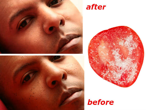  മുഖക്കുരുവിന്