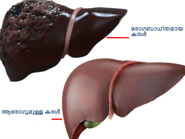  കരളിനെ ക്ലീന്‍ ചെയ്യുന്നു