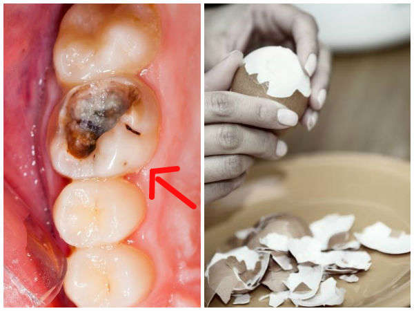 മുട്ടത്തോടു കൊണ്ട് പല്ലിലെ പോട് മാറ്റാം