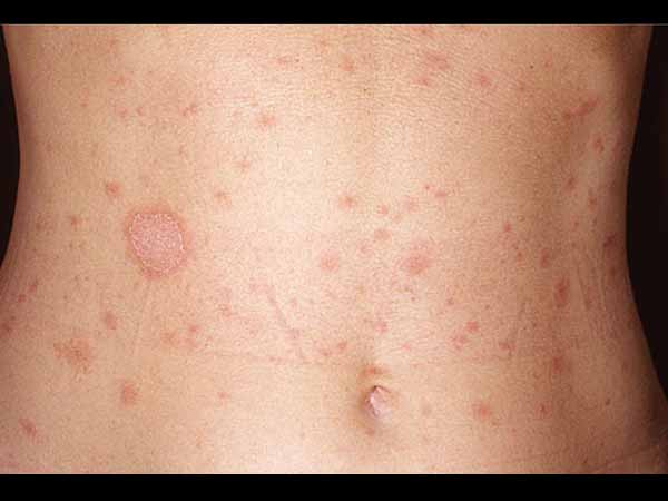 വയറ്റില്‍ പാടുകളെങ്കില്‍