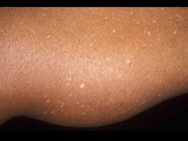  തുടകളിലാണെങ്കില്‍