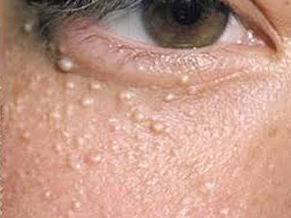  കണ്ണിനു താഴെ പാടുകളെങ്കില്‍