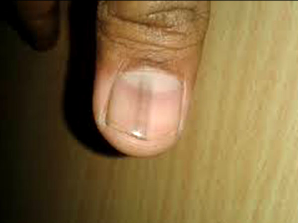  രക്തത്തില്‍ ഓക്‌സിജന്‍ കുറവ്